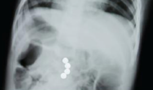 Hazard of Magnets - x-ray of body with magnets in it